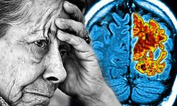 Türkiye’de Alzheimer alarmı yükseltiyor!