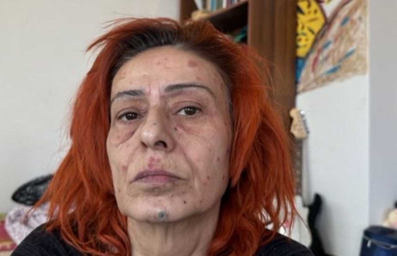 Yıldız Tilbe Saçını Boyarken Yüzünü Yaktı!1