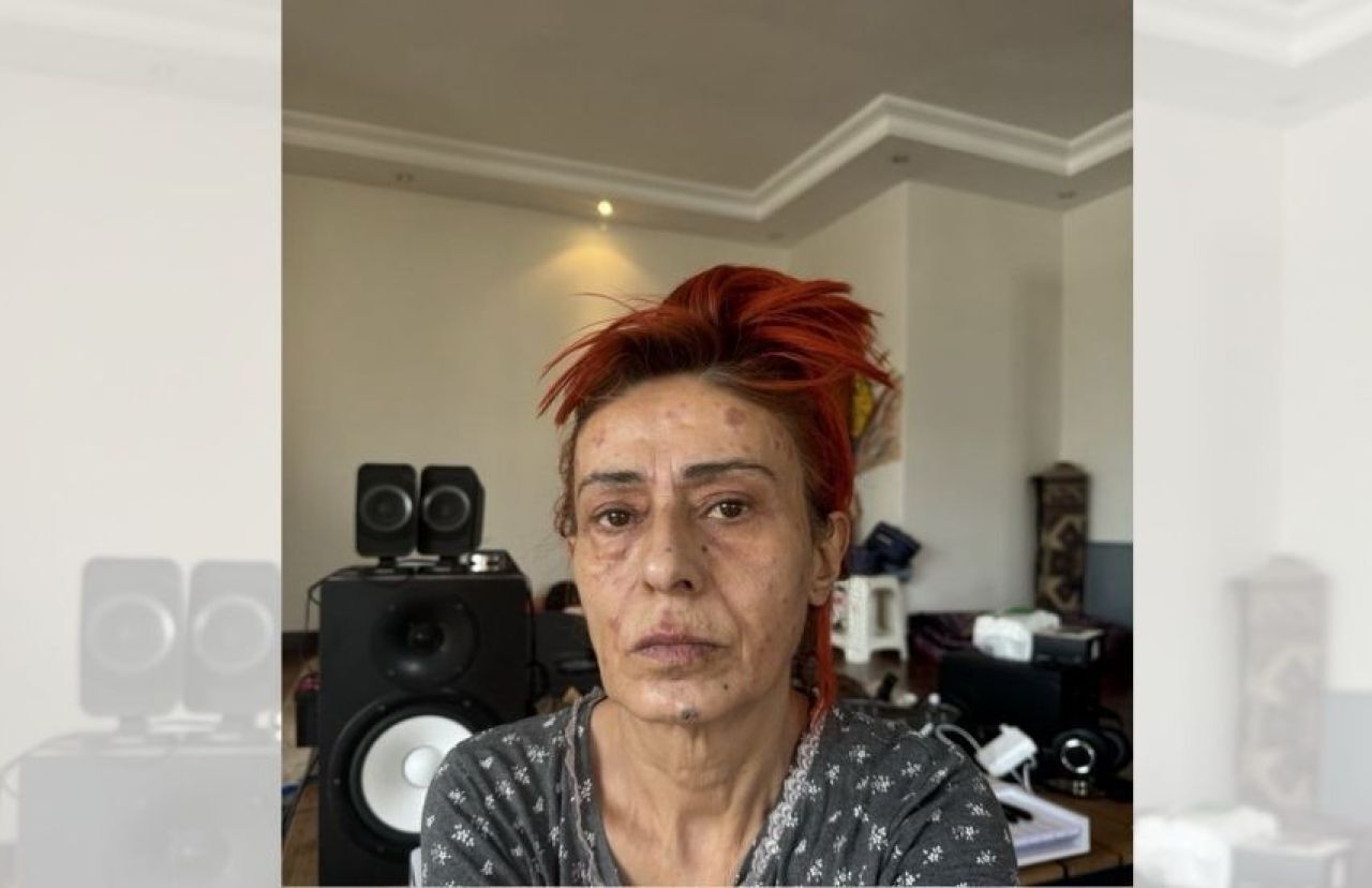 Yıldız Tilbe Saçını Boyarken Yüzünü Yaktı!2
